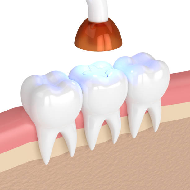 Dental Fillings in Chicago, IL