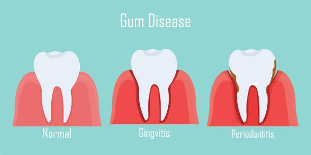 Gum Disease