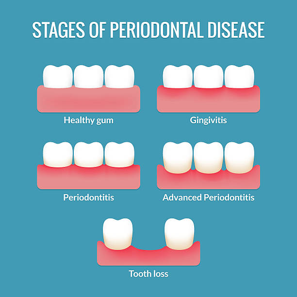 Infographic - Stages of Periodental Disease