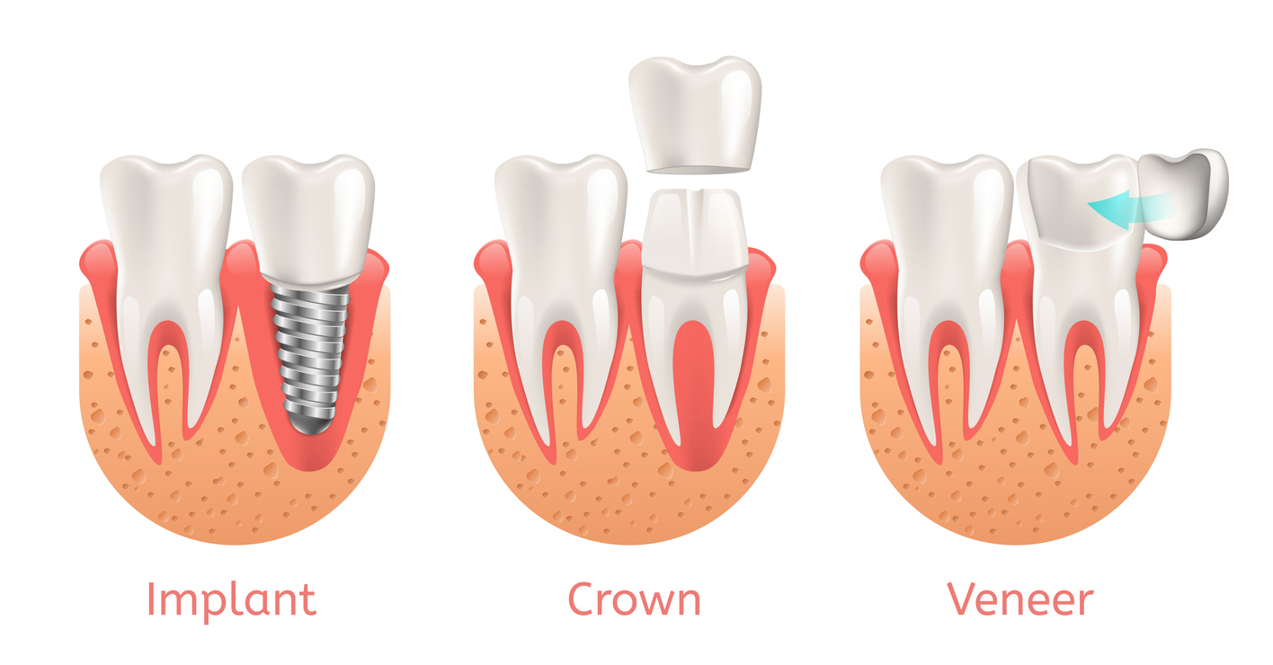 Dental Procedure - Dental Implant, Dental Crown and Porcelain Veeners