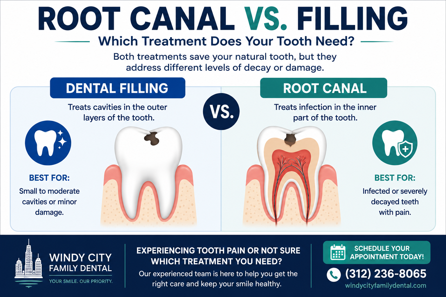 root canal vs cavity filling